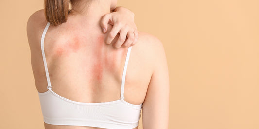 Soothing Psoriasis with Effective Home Remedies