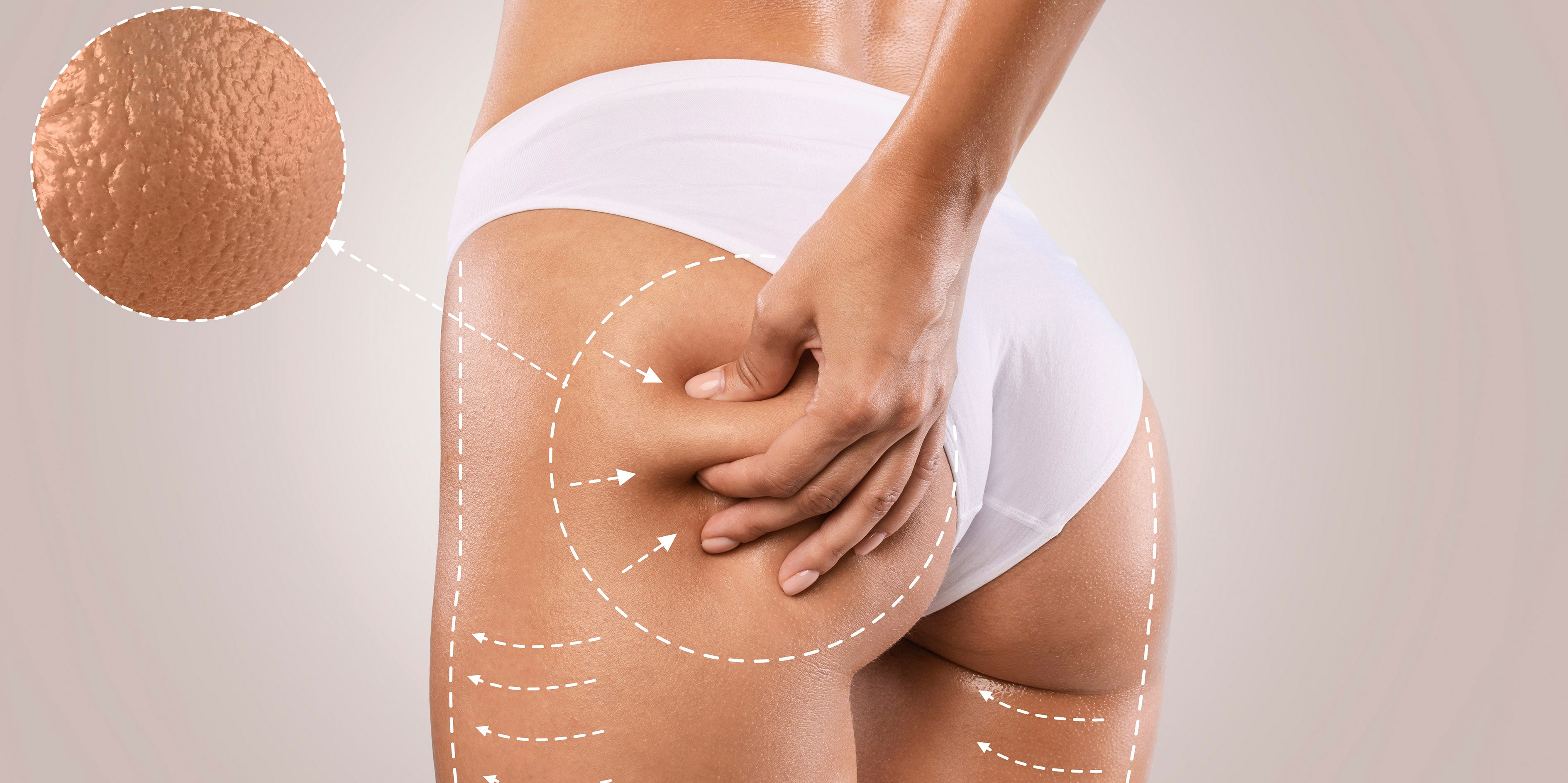 How to Get Rid of Cellulite: The Top 7 Effective Solutions You