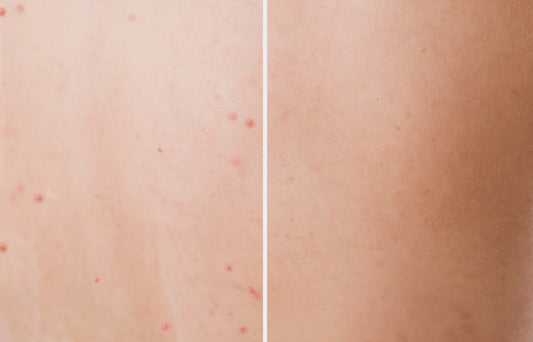 Back Acne - Cuases, Treatment and Prevention