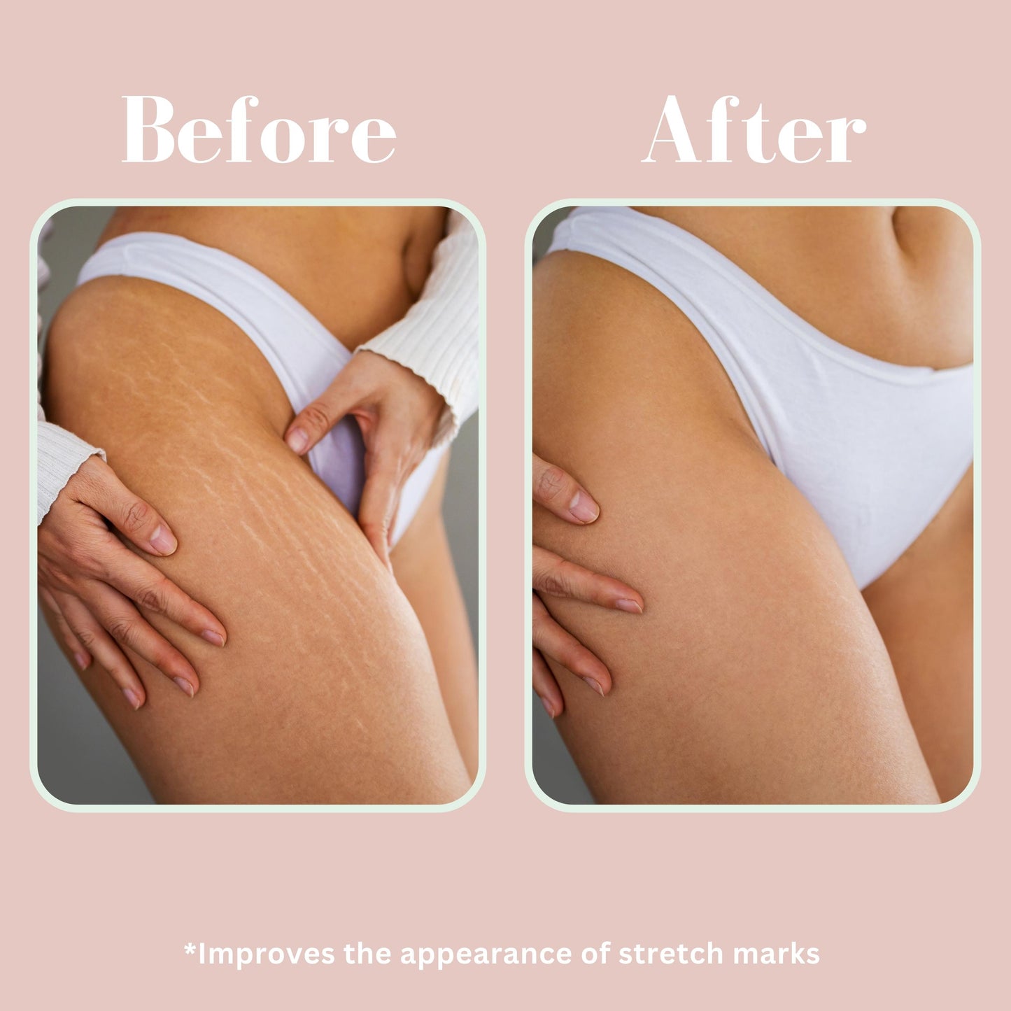 coffee scrub before and after stretch marks