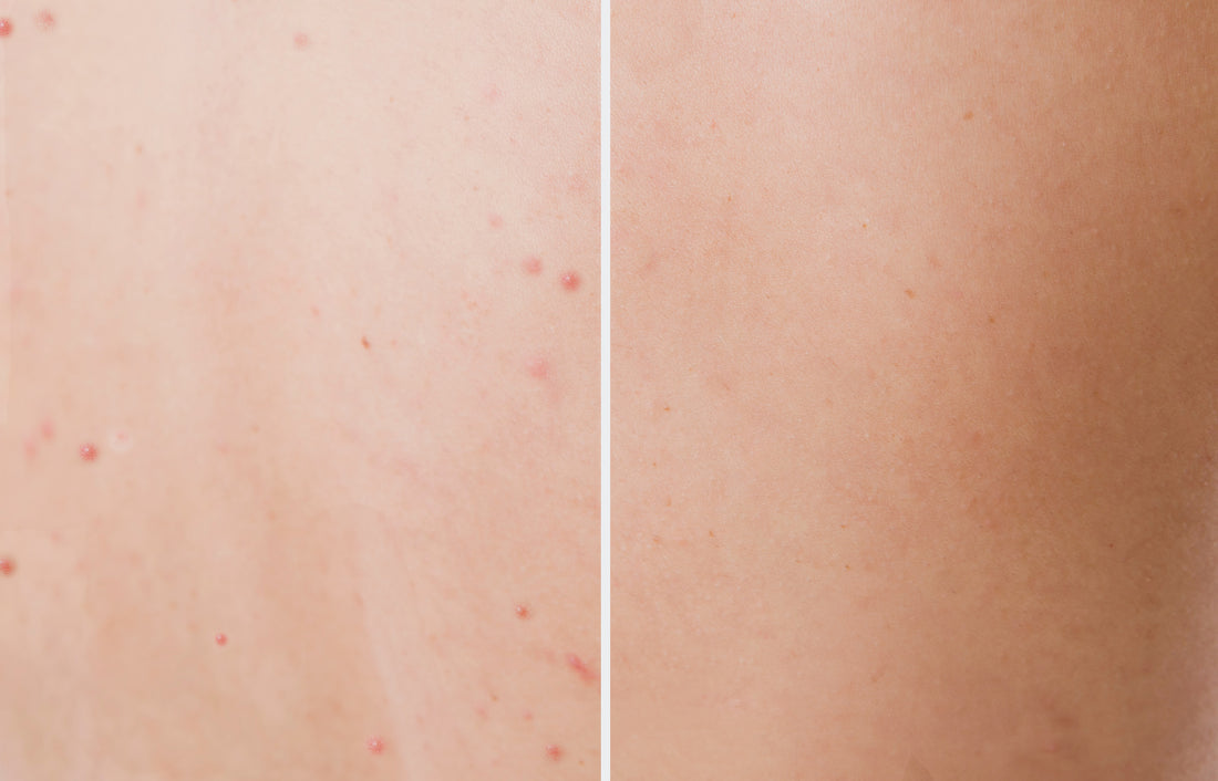 Back Acne - Cuases, Treatment and Prevention