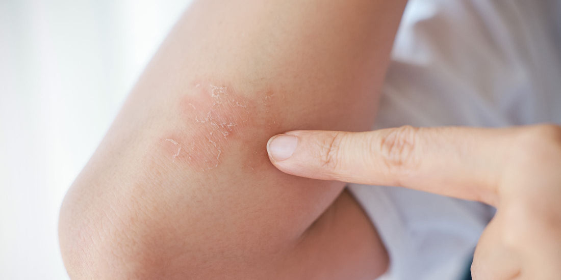 How to Effectively Treat and Prevent Dry Patches on Your Body