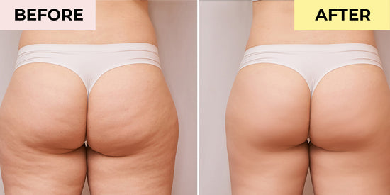 How to Reduce Cellulite in a Week – Life's Butter
