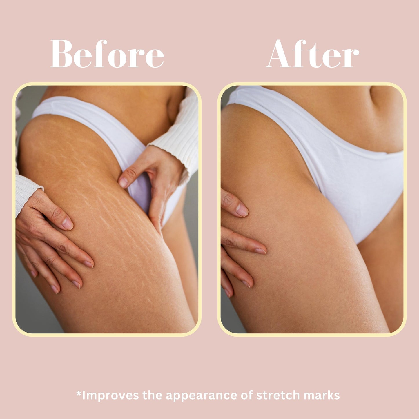 The coffee scrub Exfoliation Bundle before and after stretch marks