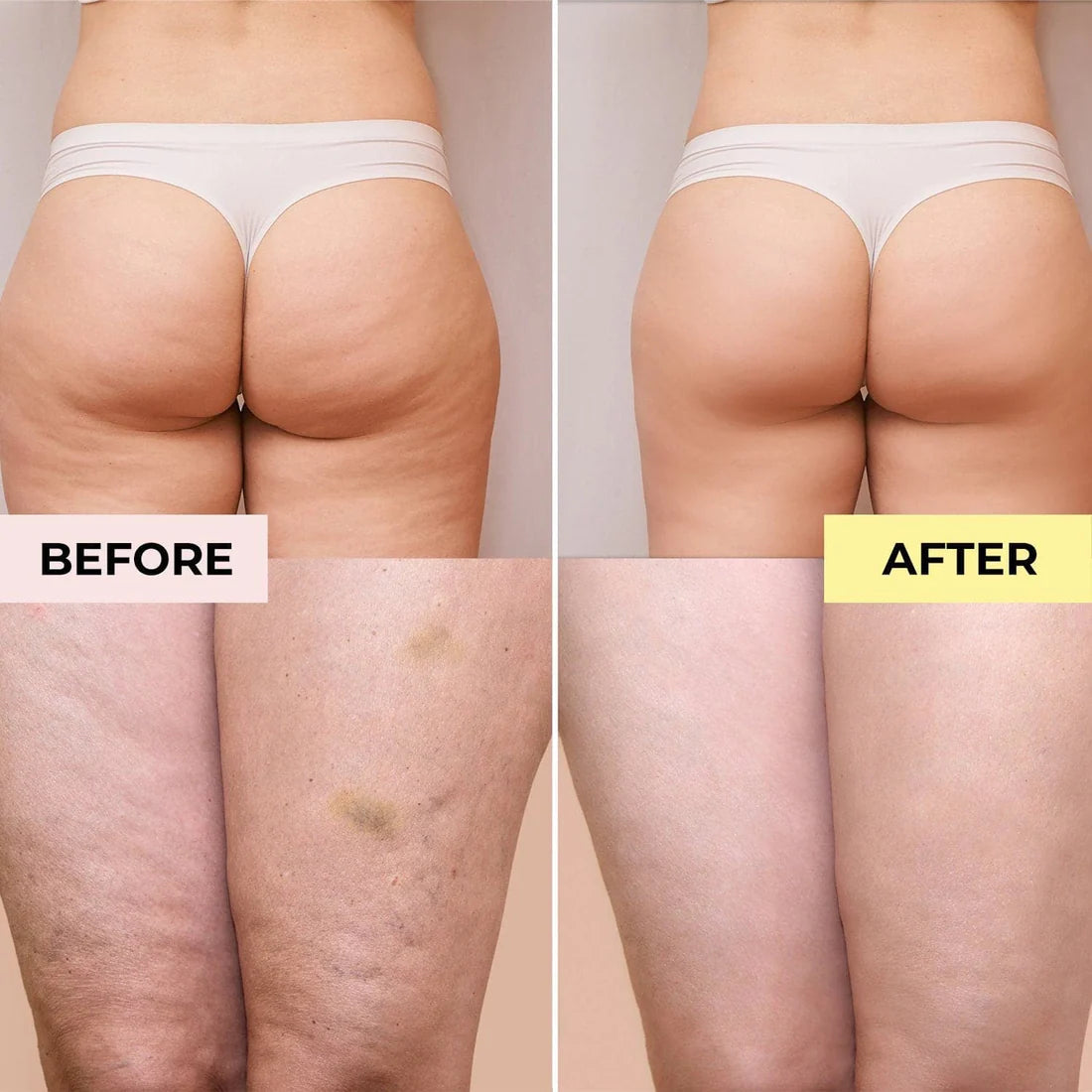 anti cellulite cream before and after