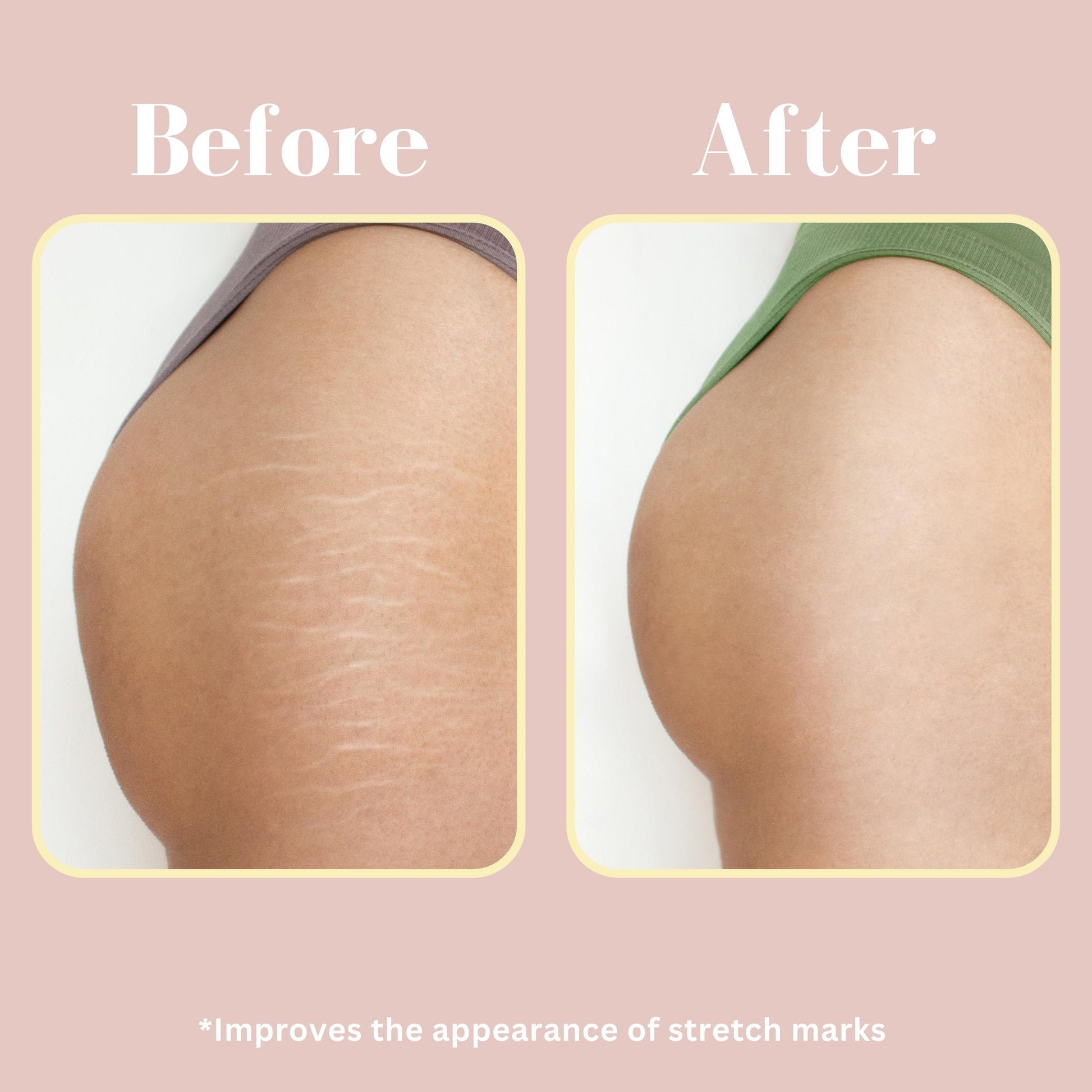 oil for stretch marks before and after